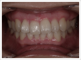 歯茎のメラニン除去（歯茎の漂白）の施術後