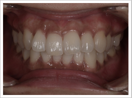 歯茎のメラニン除去（歯茎の漂白）の施術前